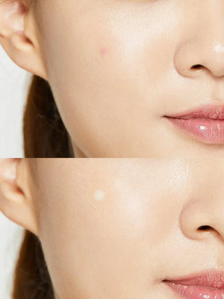 Buy COSRX Acne Pimple Master Patch | Best Korean Skincare for Acne | 24 Patches | MercelBay Clear acne fast with COSRX Acne Pimple Master Patch 24 pcs. Fragrance-free, oil-absorbing, skin-protecting patches. Shop better deals at MercelBay vs Ulta, Walmart, Kohl’s.